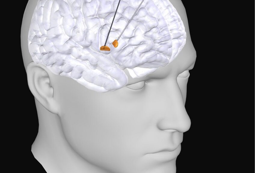 New Electrical Signature Discovered for Parkinson’s Disease